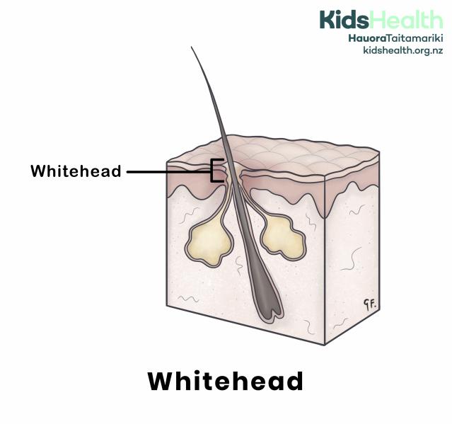An illustration of a whitehead under the skin. The cross-section shows a hair follicle with a blocked pore. A label points to the whitehead near the skin surface.