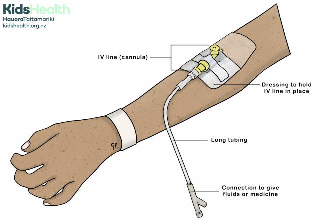 An illustration showing a child’s arm with an IV line (cannula) inserted into a vein. The IV line is held in place with a dressing and connects to long tubing used to give fluids or medicine.
