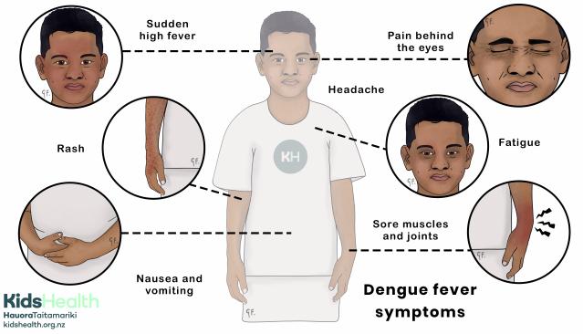 An illustration showing common symptoms of dengue fever in children, including high fever, rash, headache, pain behind the eyes, sore muscles and joints, fatigue, and nausea and vomiting.