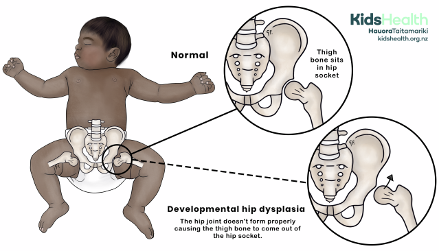 An illustration showing a baby lying on their back with legs bent and turned outward. A close-up comparison shows a normal hip joint where the thigh bone sits in the socket, and another with developmental hip dysplasia where the thigh bone has slipped out of the hip socket.