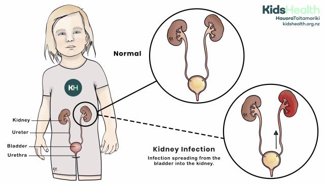 Illustration of a young child with the urinary system labeled, showing the kidneys, ureters, bladder, and urethra. Enlarged views depict a normal urinary system and a kidney infection where the infection spreads from the bladder to the kidney, with one kidney highlighted in red to indicate inflammation.