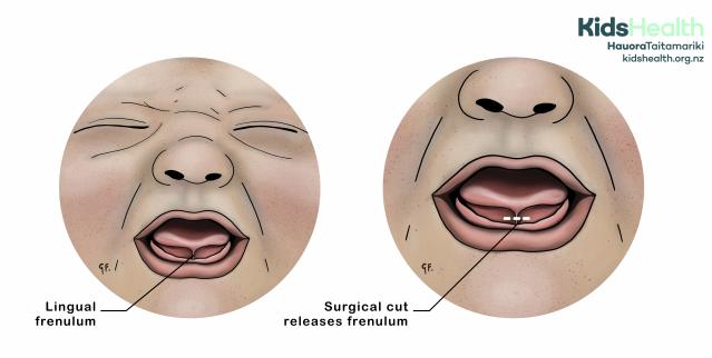 An illustration showing a baby with a tongue-tie. The first image shows the lingual frenulum under the tongue, and the second image shows the same frenulum with a dotted white line indicating where a surgical cut (frenotomy) would release it.