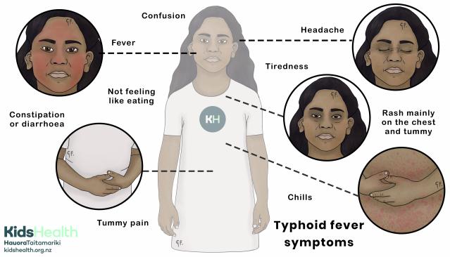 An illustration showing common symptoms of typhoid fever in children, including fever, confusion, headache, tiredness, rash, chills, tummy pain, constipation or diarrhoea, and loss of appetite.