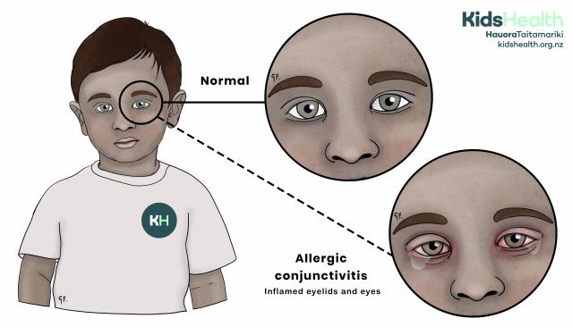 An illustration showing the difference between a normal eye and allergic conjunctivitis, which causes swollen, red, and irritated eyes.