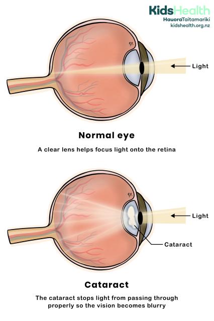 A side-view illustration compares how light enters a normal eye and an eye with a cataract. In the normal eye, light passes clearly through a transparent lens to reach the retina. In the cataract image below, a cloudy patch in the lens blocks the light, making it scatter.