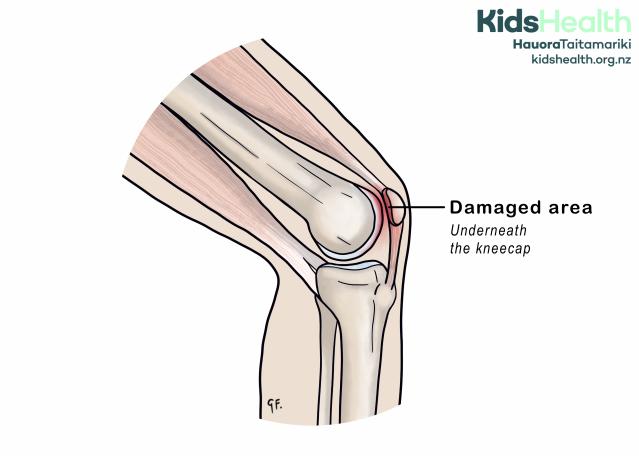 An illustration showing the knee joint with a damaged area underneath the kneecap.