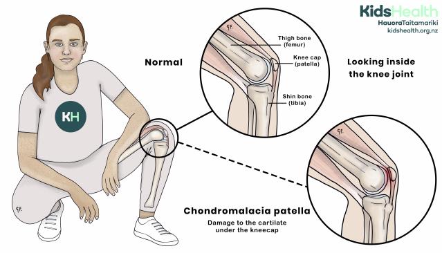 An illustration showing normal knee anatomy compared with chondromalacia patella, where there is damage to the cartilage under the kneecap.