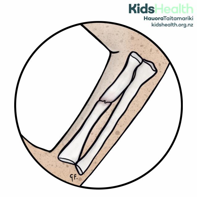 An illustration of a closed fracture showing a clean break through the arm bone (radius) beneath the skin, without any open wound.