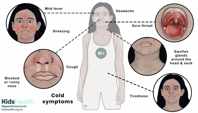 An illustration showing common cold symptoms, including fever, sneezing, cough, blocked nose, sore throat, swollen glands, headache, and tiredness.