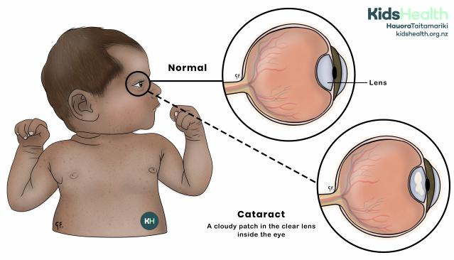 A baby is shown with two close-up circle images of the eye. One circle shows a normal clear lens, and the other shows a cloudy cataract inside the lens.