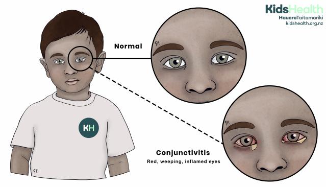 An illustration showing the difference between a normal eye and conjunctivitis, which causes red, inflamed, and weeping eyes.