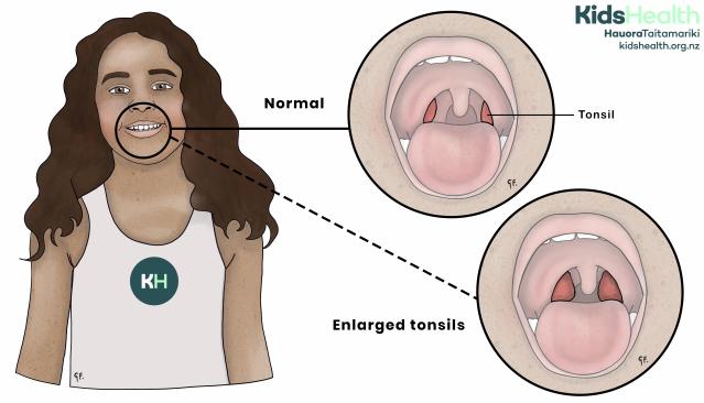 An illustration comparing normal tonsils with enlarged tonsils at the back of the throat.