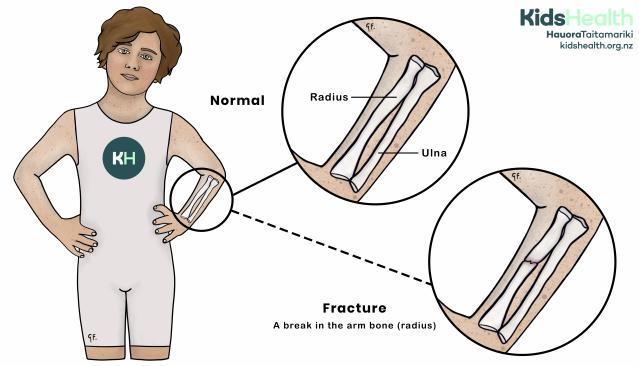 An illustration showing the difference between a normal forearm and a fractured arm bone (radius).