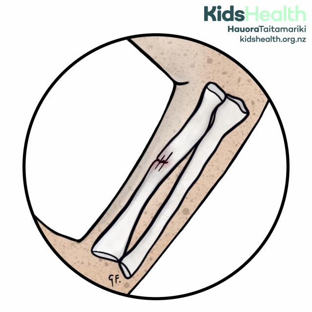 An illustration of a greenstick fracture showing a partial crack in the arm bone (radius), where the bone bends and splinters on one side without breaking completely.