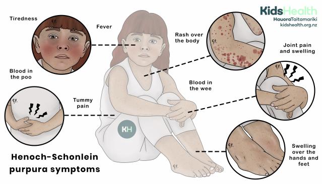 An illustration of a child sitting with multiple close-up circles showing the symptoms of Henoch-Schönlein purpura, including tiredness, fever, rash over the body, joint pain and swelling, swelling over the hands and feet and tummy pain,.
