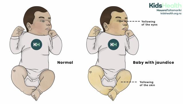 An illustration comparing a normal baby with a baby who has jaundice. The baby with jaundice has yellowing of the skin and eyes.