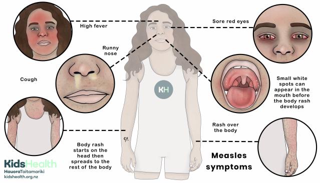 An illustration of a child with multiple close-up circles showing the symptoms of measles, including high fever, runny nose, cough, sore red eyes, small white spots in the mouth, and a widespread body rash.