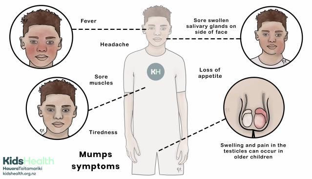 An illustration showing symptoms of mumps in a child, including fever, headache, swollen salivary glands, sore muscles, tiredness, loss of appetite, and testicular pain in older children.
