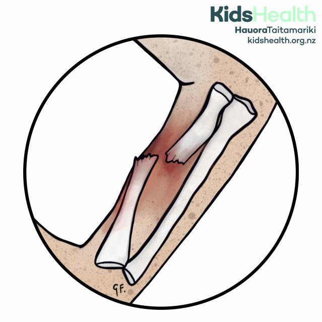 An illustration of an open fracture showing a broken arm bone (radius) that has snapped into two pieces with jagged edges and redness around the break, indicating injury to the surrounding tissue.