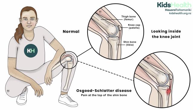 An illustration showing Osgood-Schlatter disease, where pain occurs at the top of the shin bone just below the kneecap.