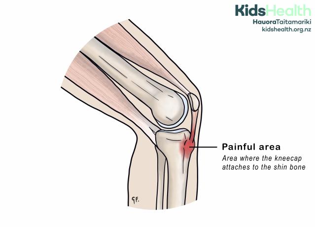 An illustration showing the knee with a painful area where the kneecap attaches to the shin bone.