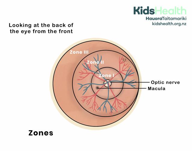An illustration showing retinopathy of prematurity zones