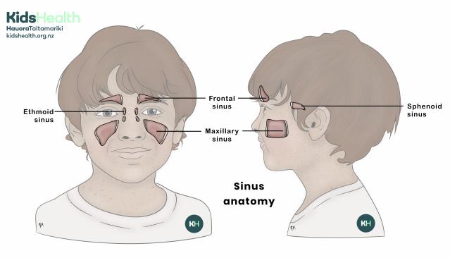 An illustration showing the locations of the frontal, ethmoid, maxillary, and sphenoid sinuses from front and side views of a child’s face.