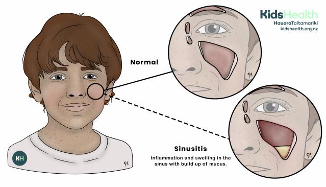 An illustration showing a child’s face with close-ups comparing a normal sinus and a sinus with sinusitis. The normal sinus is clear and open, while the sinus with sinusitis is red, swollen, and filled with yellow mucus.