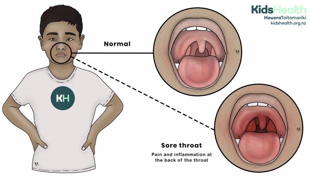 Illustration showing a child with a normal throat compared to a sore throat, which is red and inflamed at the back.