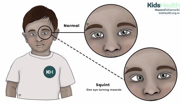 An illustration comparing a normal eye alignment with a squint, where one eye turns inwards.