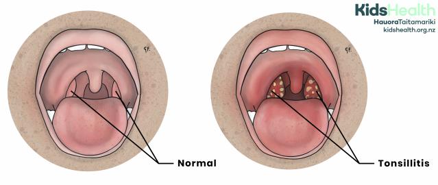 An illustration comparing a normal throat with a throat showing tonsillitis, where the tonsils appear red and have yellow patches.