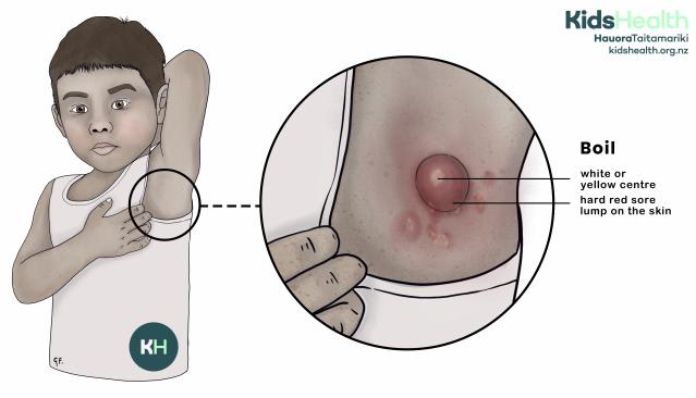 Illustration showing a child lifting their arm to show a boil under the arm, with a close-up highlighting the white or yellow centre and the hard red lump.