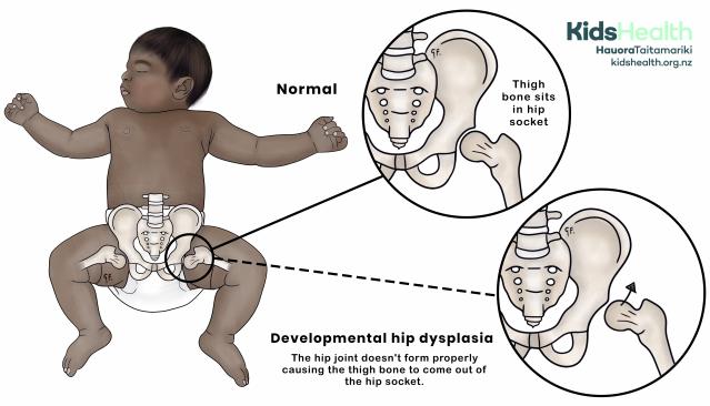 An illustration showing a baby lying on their back with legs bent and turned outward. A close-up comparison shows a normal hip joint where the thigh bone sits in the socket, and another with developmental hip dysplasia where the thigh bone has slipped out of the hip socket.