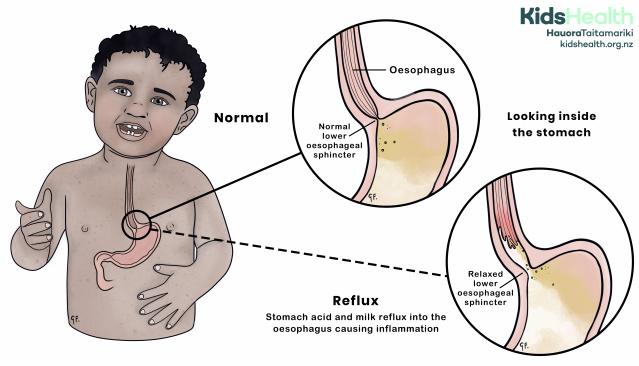 Illustration showing reflux in a child, comparing a normal lower oesophageal sphincter with a relaxed sphincter that allows stomach contents to flow back into the oesophagus.