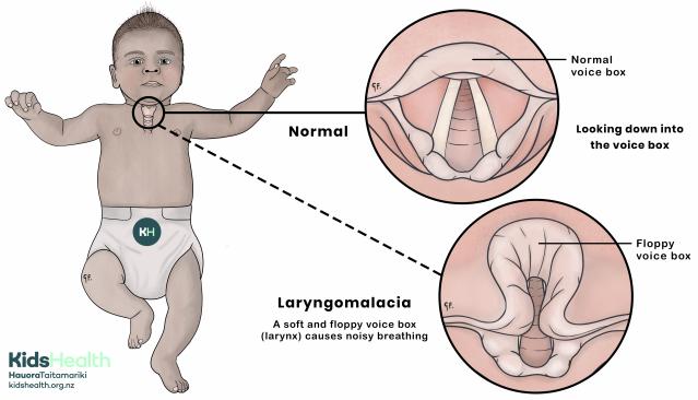 Illustration of a baby with a close up of their voice box comparing a normal upper airway to laryngomalacia