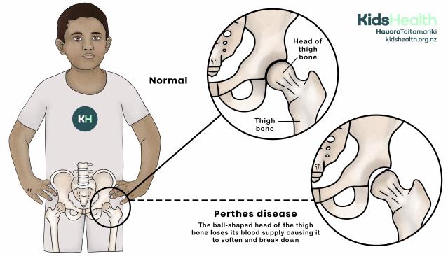 Illustration showing Perthes disease, with a comparison between a normal hip joint and a hip where the head of the thigh bone has broken down.