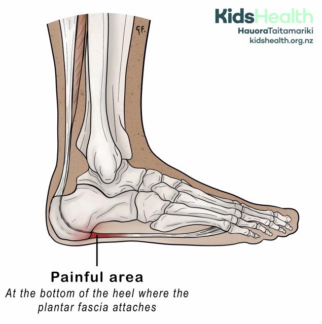 Illustration of the bones of the foot showing the painful area at the bottom of the heel where the plantar fascia attaches.