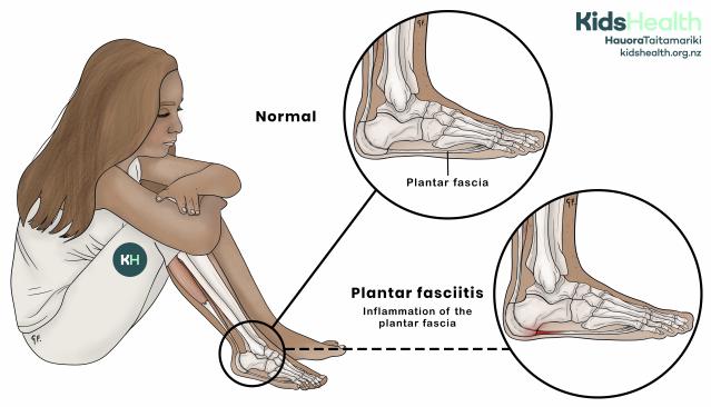 Illustration showing a young person with foot pain, with close-up comparisons of a normal foot and a foot with plantar fasciitis.