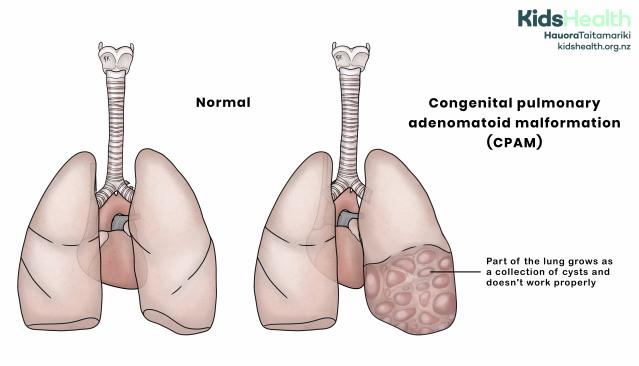 Illustration comparing normal lungs with congenital pulmonary adenomatoid malformation, where part of one lung is made up of cysts and does not work properly.