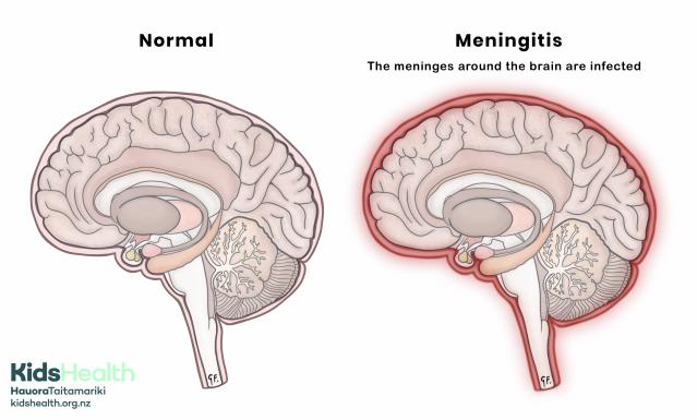 Illustration comparing a normal brain with a brain affected by meningitis, showing inflamed meninges around the brain.