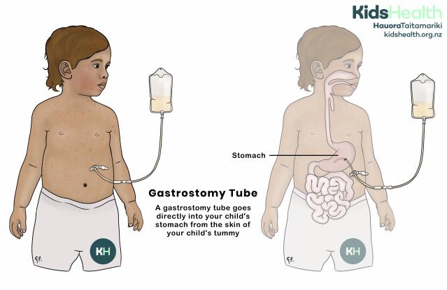 Illustration of a child with a gastrostomy tube going directly into the stomach through the skin of the tummy, with a feeding bag attached.