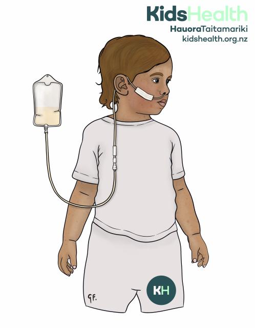 Illustration of a child with a feeding tube going through the nose and connected to a feeding bag.
