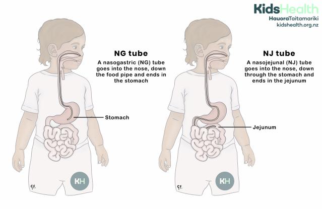 Illustration comparing a nasogastric tube that ends in the stomach and a nasojejunal tube that passes through the stomach and ends in the jejunum.
