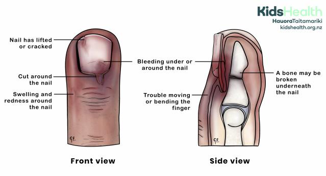 Illustration showing signs of a fingertip injury, including a lifted nail, bleeding, swelling, and possible bone injury.