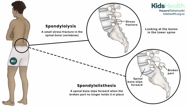 Illustration showing spondylolysis with a small stress fracture and spondylolisthesis where a spinal bone slips forward.