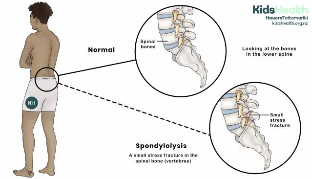 Illustration showing a comparison between a normal lower spine and spondylolysis with a small stress fracture in a vertebra.