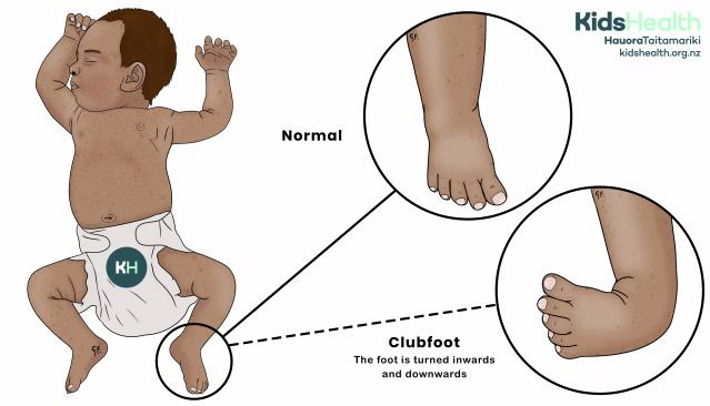 Illustration showing a baby with one foot turned inwards and downwards (clubfoot), compared with a normal foot.