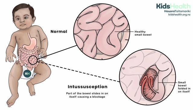 Illustration of a child showing the digestive system, with close-up diagrams comparing a normal small bowel and intussusception. The intussusception diagram shows part of the bowel folding in on itself and causing a blockage.