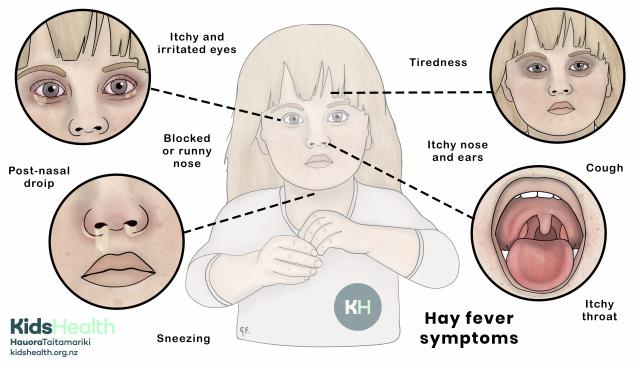 Illustration of a child showing common hay fever symptoms, including itchy eyes, runny nose, sneezing, post-nasal drip, cough, itchy throat, and tiredness.