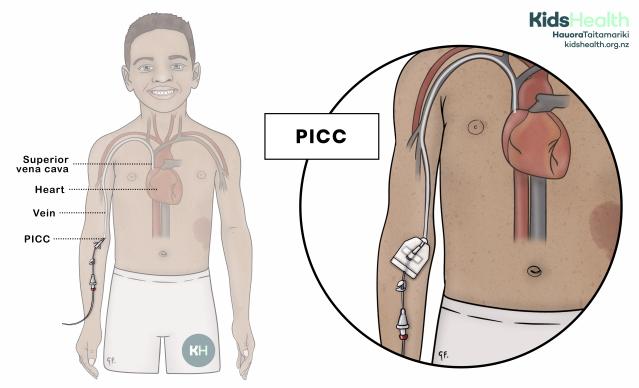 Child with a peripherally inserted central catheter (PICC) in a vein of the upper arm. A magnified view shows the PICC secured to the arm with a dressing and passing through a vein to the superior vena cava near the heart.